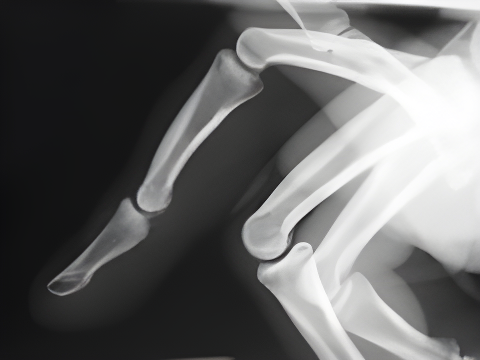 X-ray showing Contracture affecting finger joints, with visible contracture on ring finger of right hand.