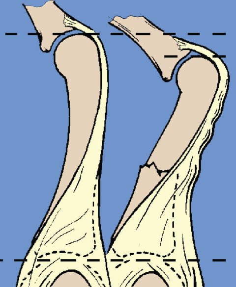 Proximal Phalanx Fracture Finger Surgery - Digit Widget