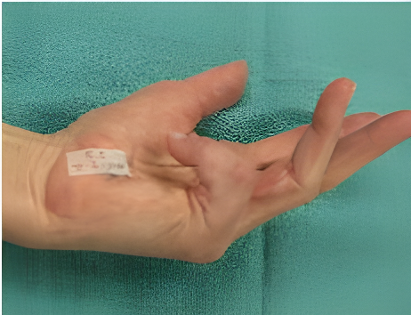 Close-up of a hand with a label on the palm, showing severe Dupuytren Contracture in the little finger, visibly curled toward the palm due to tightened tissue.