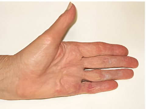 Post-operative hand showing significant improvement in finger extension after using the Digit Widget, with reduced contracture and visible healing.