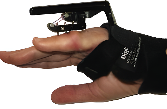 A hand wearing the Digit Widget device after finger surgery for Dupuytren Contracture, applying dynamic tension to gradually extend the little finger.