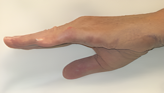 Side view of the same hand after treatment for Dupuytren Contracture, displaying restored finger alignment and nearly full range of motion.