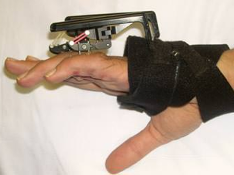 Treat finger deformity in PIP joint early to restore hand function ...