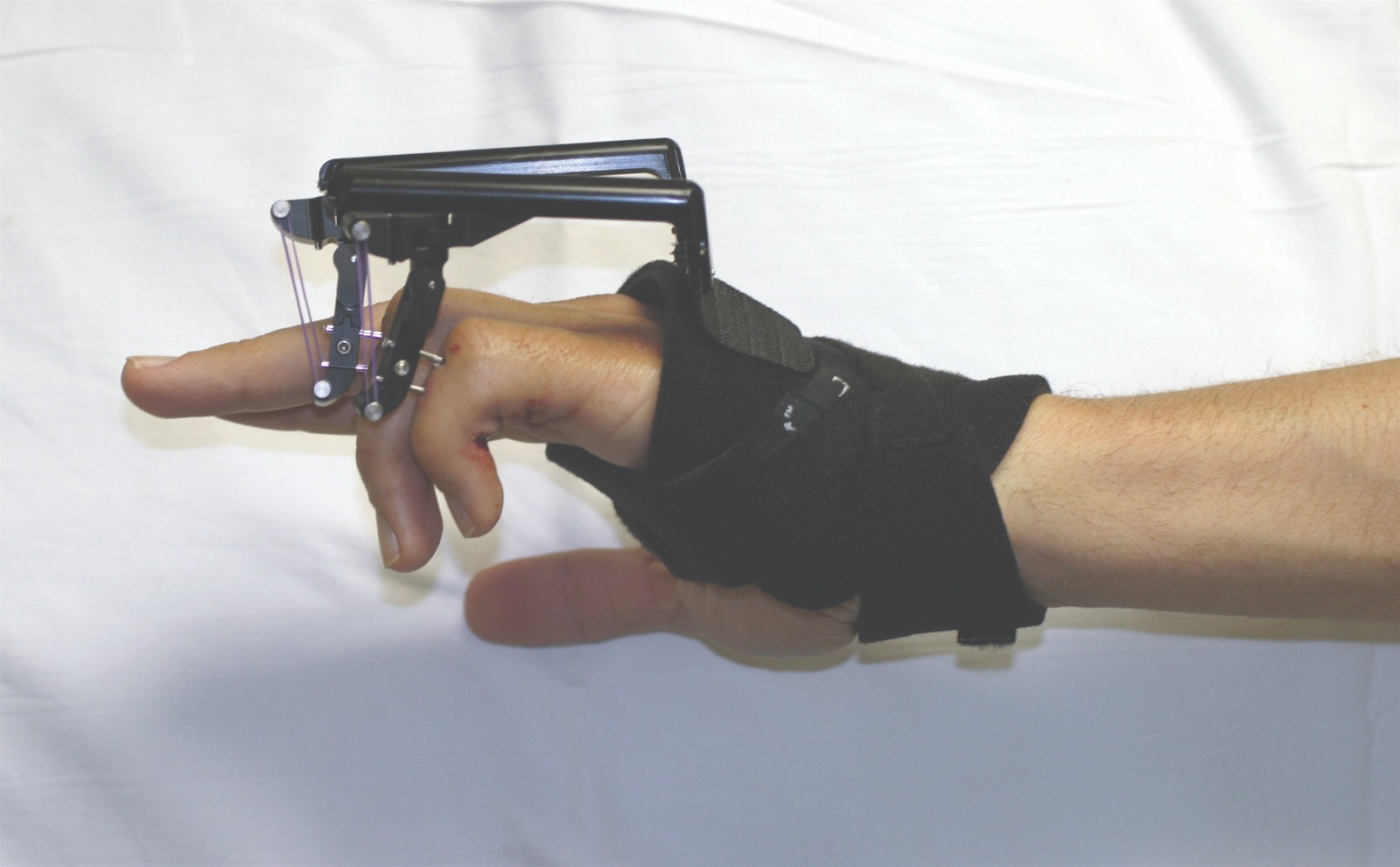 Hand wearing a Digit Widget device applying extension force to correct a PIP joint flexion contracture.