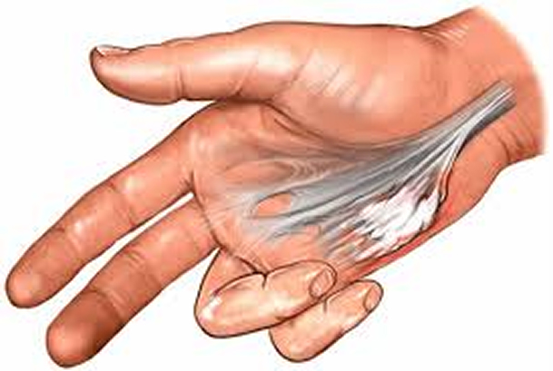 Digit Widget kit containing traction device parts, brace components, and accessories used to restore motion in a contracted finger. 