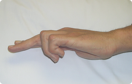 Finger for Fasciectomy